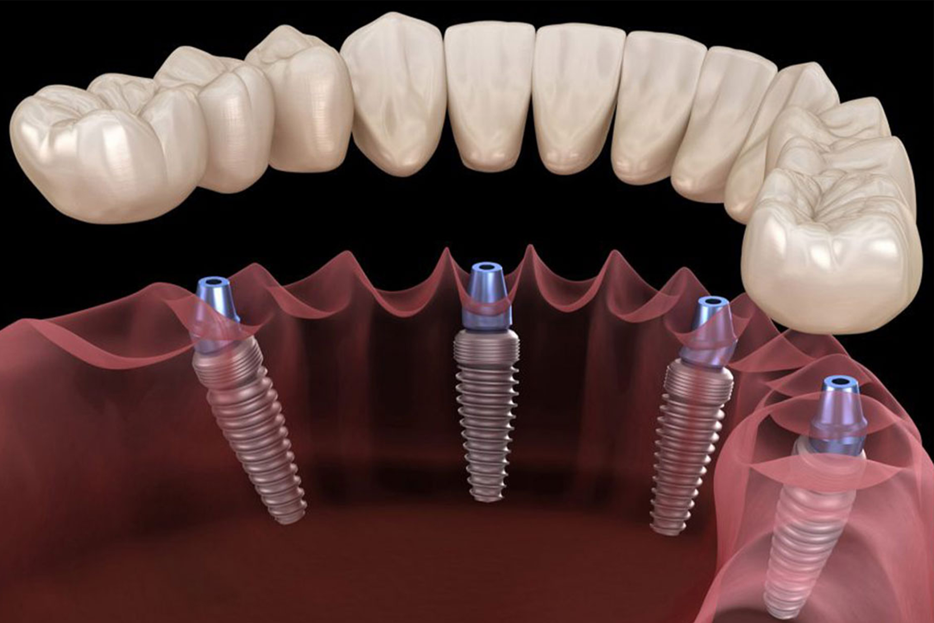 DentalImplants.jpg