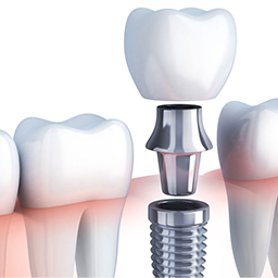 DentalImplants_small.jpg